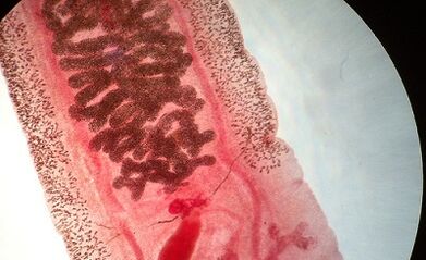 Anquilostomosis pada manusia